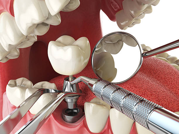 Best Emergency Root Canal Treatment in Norco, LA